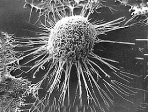 cancro immagine cellula tumorale